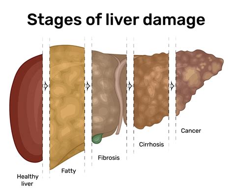 Liver Disease Aurora Health Care