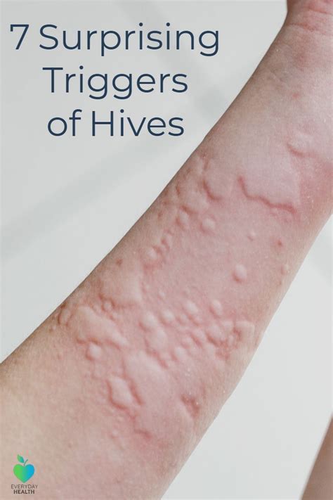 Did You Know A Workout Can Trigger Hives Exerciseurticaria