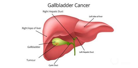 Gallbladder Surgery