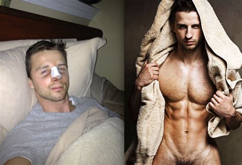 SHOCKING Before And After Photos Of Gay Porn Star Turned Male Escort Simon Dexter S Nose Job