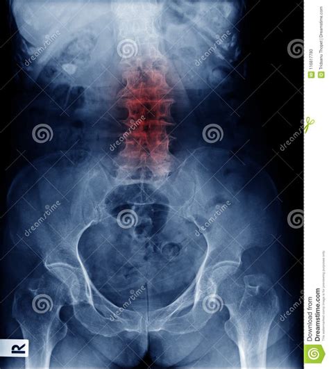 It is important to come to a clear diagnosis and to. Lumbar Spondylosis X-ray Image Stock Photo - Image of ...