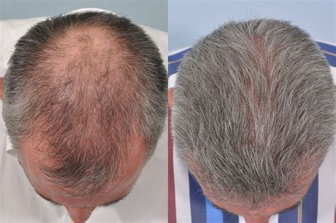 Details More Than Hair Transplant Before And After In Eteachers