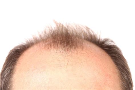 Best Hair Loss Treatments — Stop Balding Now And Regrow Lost Hair By