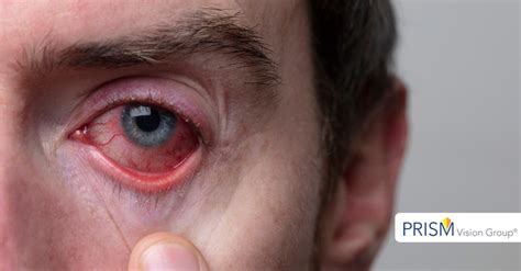 The Dangers Of Redness Relief Eye Drops Eye Associates