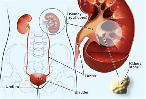However, they can develop anywhere along your urinary tract, which consists of these parts This illustration shows the path a kidney stone takes to ...