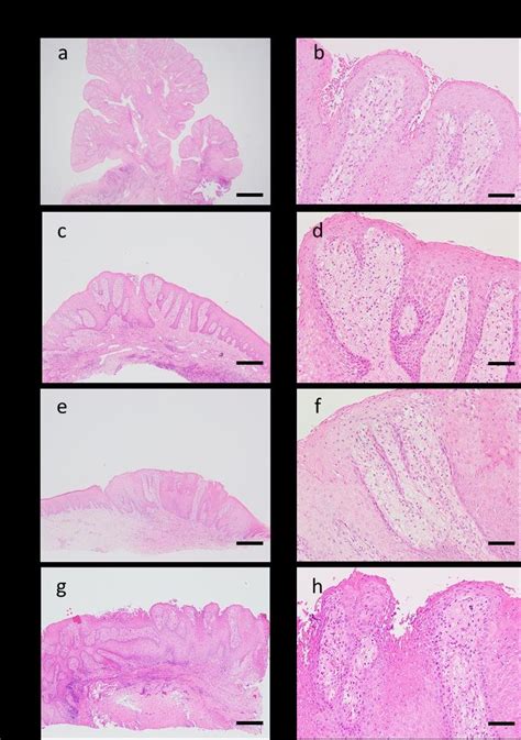 Morphological Findings Of Oral Verruciform Xanthoma Epithelial