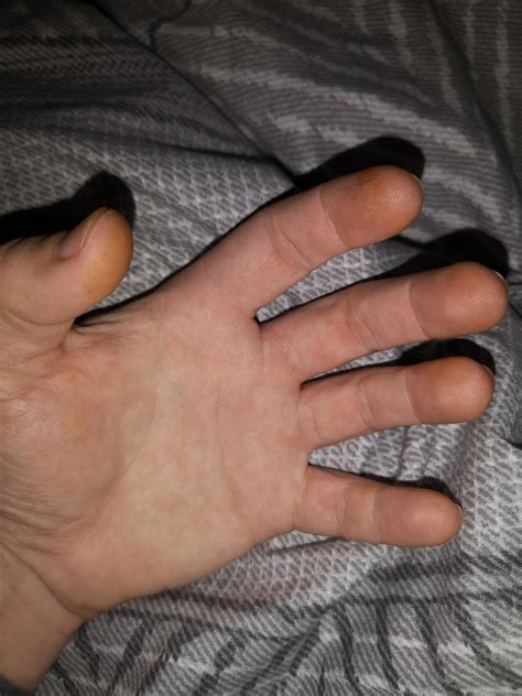 Fingertips Are Turning Orange Orange Spots On Hands Too Why Rmedical
