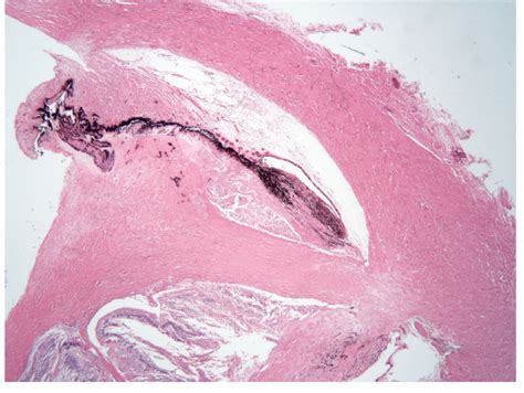 Histopathology Of The Enucleated Eye Of Case 11 The Limbus In The