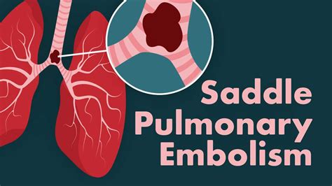 What Is A Saddle Pulmonary Embolism Pe Ausmed