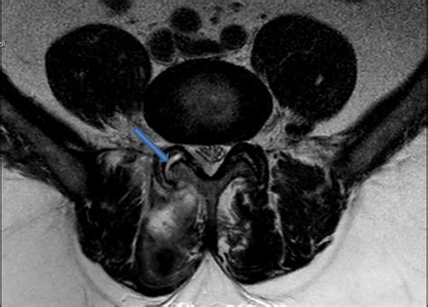 T2t Weighted Mri Image Showing Fluid Collection In The Right Facet