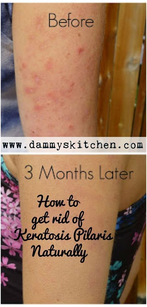 How To Get Rid Of Arm Bumps A K A Keratosis Pilaris Or Chicken Skin