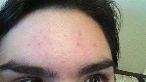 Severe Acne Still At Age 20 Adult Acne Forum