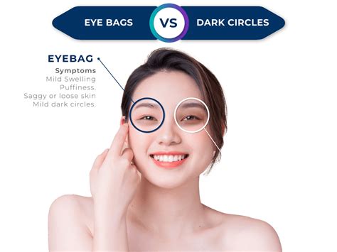 Dark Circles And Eyebag Ko Skin Specialist