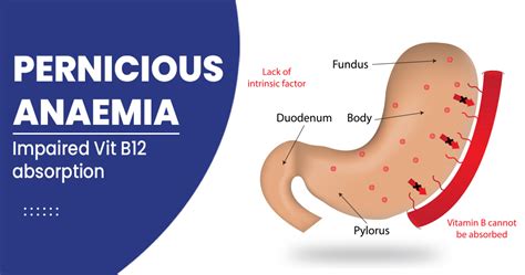 Pernicious Anaemia Symptoms Causes Diagnosis And Treatments