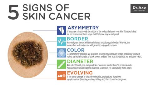 Top 5 Skin Cancer Symptoms 4 Natural Treatments