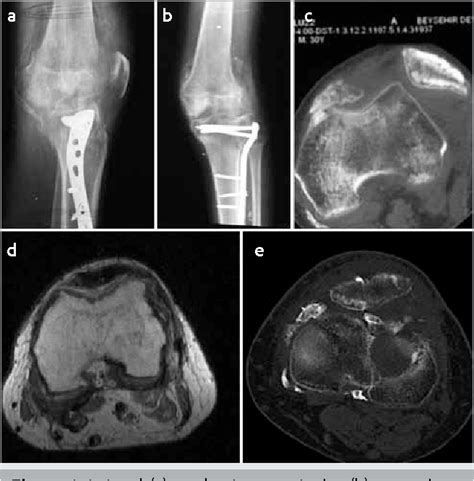 Figure 1 From A Case Of Neglected Patella Dislocation Related To Tibial