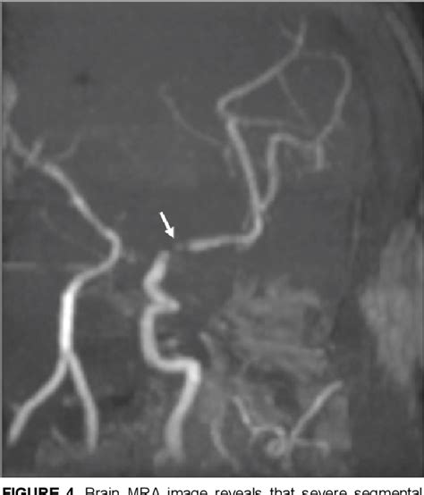 Figure 4 From Post Traumatic Middle Cerebral Artery Dissection