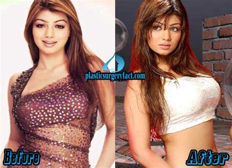 Ayesha Takia Plastic Surgery Before And After Photos Plastic Surgery