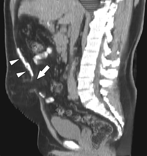 Abdominal Wall Hernias Mdct Findings Ajr