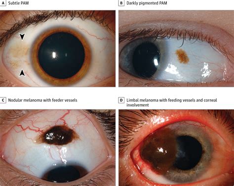 Clinical Features Differentiating Benign From Malignant Conjunctival