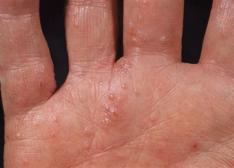 Dyshidrosis On Hands Pictures 54 Photos And Images