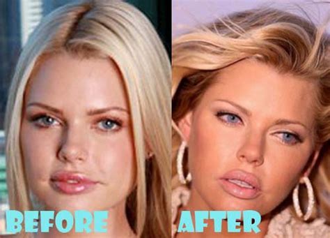 Sophie Monk Plastic Surgery Before And After Photos Lovely Surgery