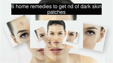 6 Home Remedies To Get Rid Of Dark Skin Patches Youtube