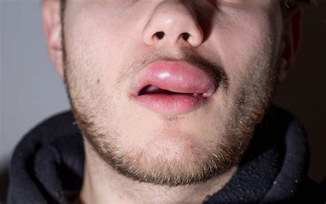 swollen lips causes symptoms and treatments vedix