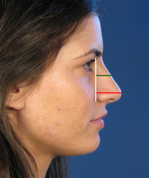 Nasal Tip Deprojection