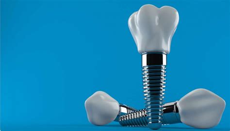 Aleaciones De Titanio Biocompatibles Para Implantes Dentales