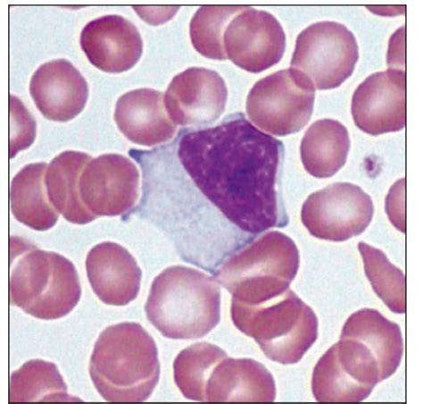 Atypical Lymphocytes Atypical Or Reactive Lymphocytes Are Lymphocytes