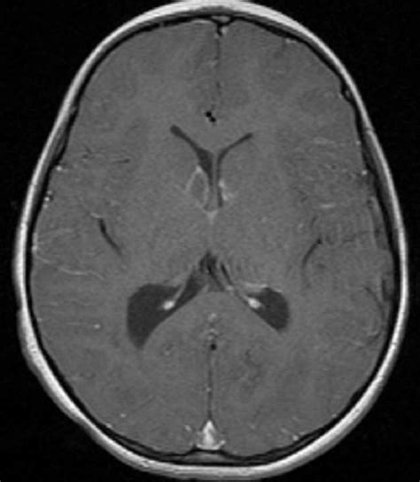 Tuberous Sclerosis Neuro Mr Case Studies Ctisus Ct Scanning