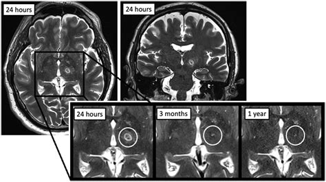 Frontiers Longitudinal Mr Imaging After Unilateral Mr Guided Focused
