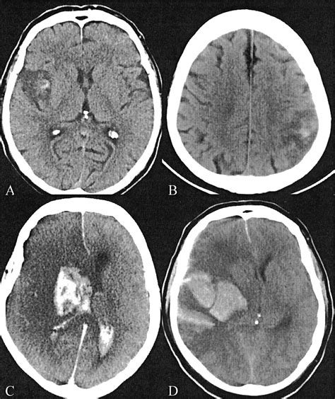 Hemorrhagic Transformation Of Ischemic Brain Tissue Stroke