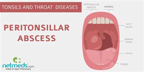 Peritonsillar Abscess Causes Symptoms And Treatment