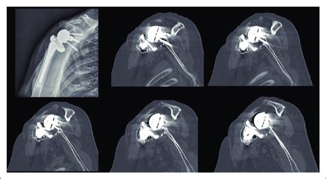 Right Shoulder Ap X Ray And Ct Scan Coronal Views At 5 Months Following