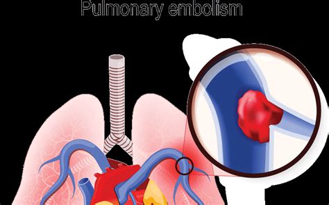 Pulmonary Embolism Type Cause Symptoms Treatment