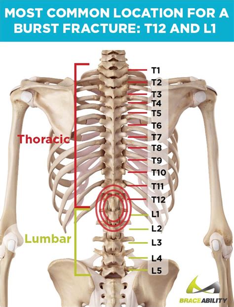 Did You Know 90 Of Burst Fractures Occur In The T5 L5 Vertebrates