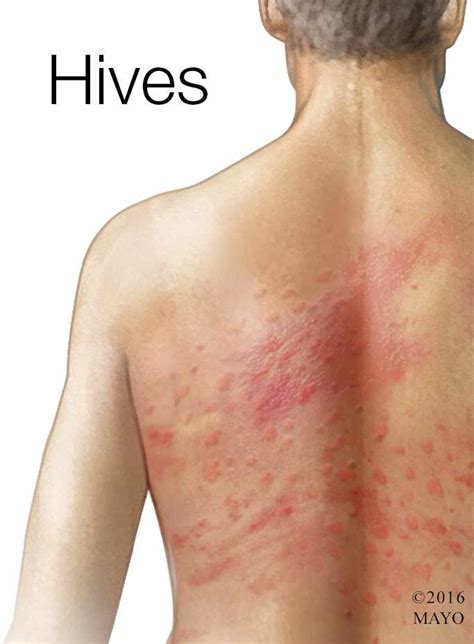 mayo clinic q and a chronic hives come and go with no clear pattern mayo clinic news network