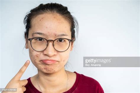 Skin Blisters Face Photos And Premium High Res Pictures Getty Images