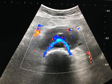 Vietnamese Medic Ultrasound Case Periaortic Lymphoma Dr Phan