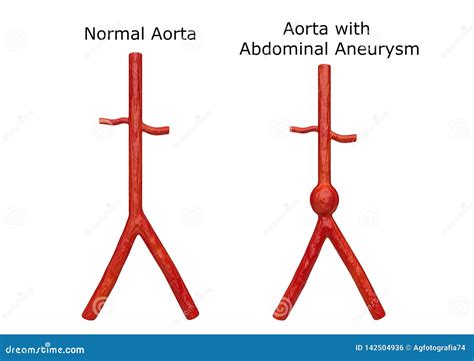 Thoracic Vs Abdominal Aortic Aneurysm