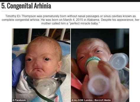 Terrifying Rare Birth Diseases That Youve Never Heard Of Photos