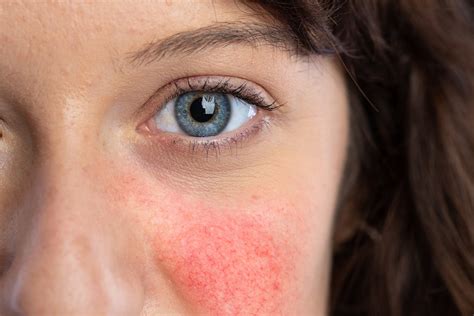 Rosacea And Your Pregnancy The Pulse