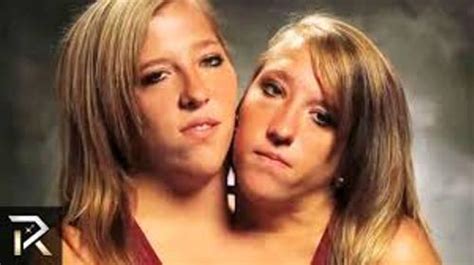 10 facts about conjoined twins fact file