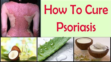 Home Remedies For Psoriasis Natural Psoriasis Shampoo Scalp