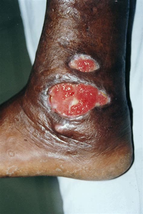 blastomycosis | Medical Pictures Info - Health Definitions Photos