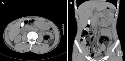 Gallbladder Visualisation After Intravenous Urography Bmj Case Reports