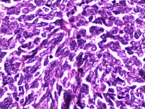 Figure From Primary Monophasic Synovial Sarcoma A Rare Pulmonary
