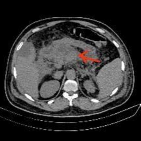 Contrast Enhanced Ct Scan Abdomen Axial View Showing Areas Of